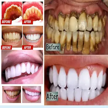 Bielenie Zubov Enzým Sodný Phytate Mint Chuť Zubnej Pasty Účinne Odstrániť Žltá Doska Dymu Škvrna Čistiace Svieži Dych