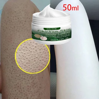 Liečenie Keratóza Pilaris Repair Cream Odstrániť Kuracie Kože Oživiť Telo Tmavé Škvrny Hladký Krém, Emulzia na Bielenie Pokožky Starostlivosti 50g