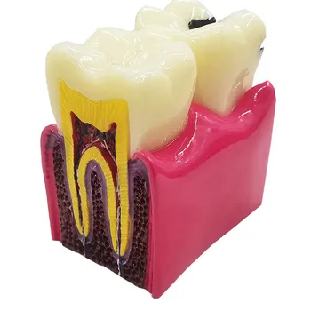 Zubné Stomatológia Zuby Model 6-Krát Kazu Comparation Študijné Modely Zubné Vzdelávania Model